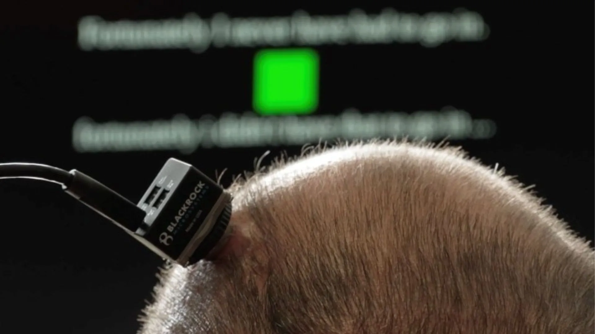 「新型腦機介面技術助癱瘓患者實時溝通」