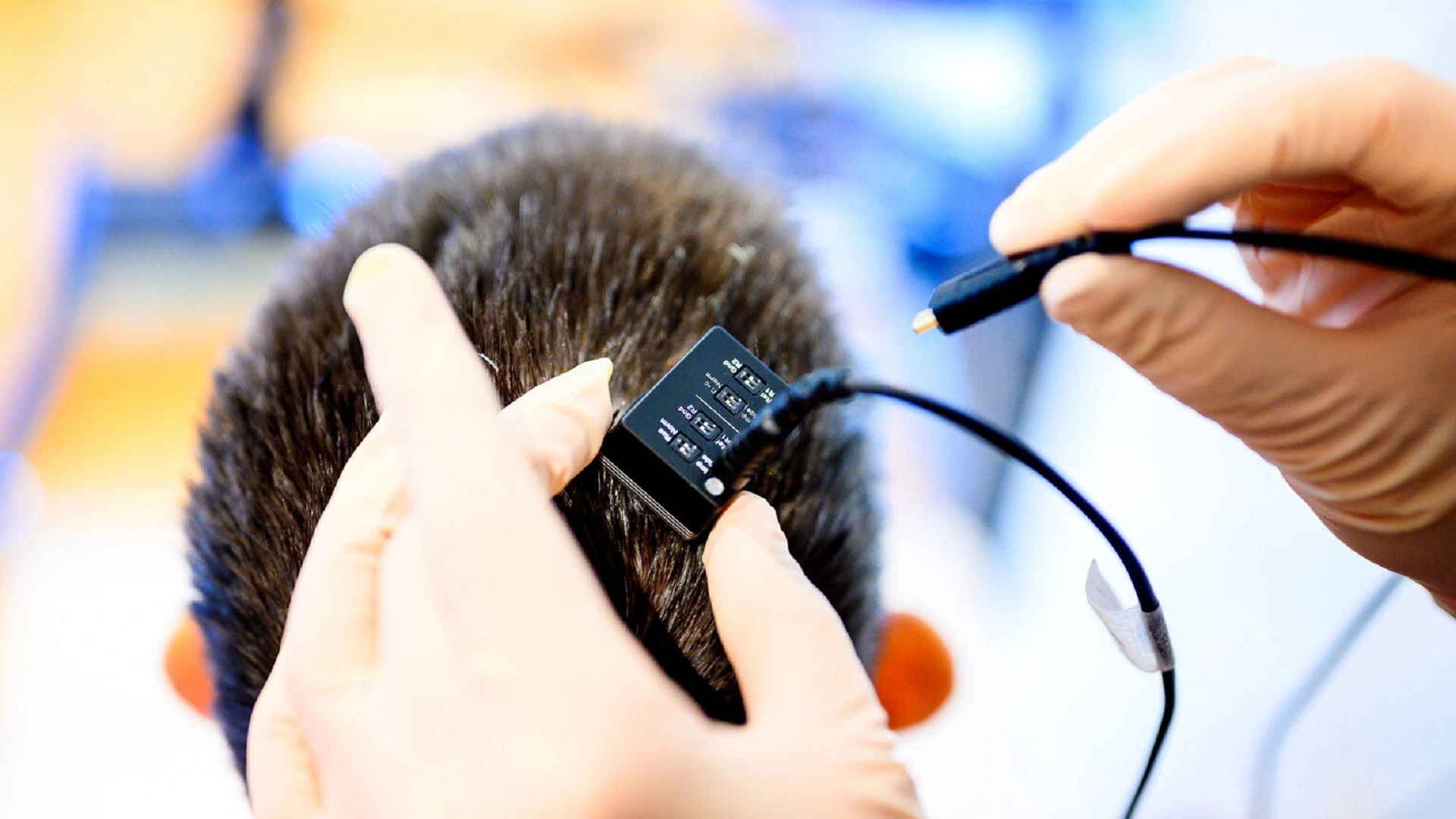 腦植入裝置助女性在中風 18 年後重拾語言能力