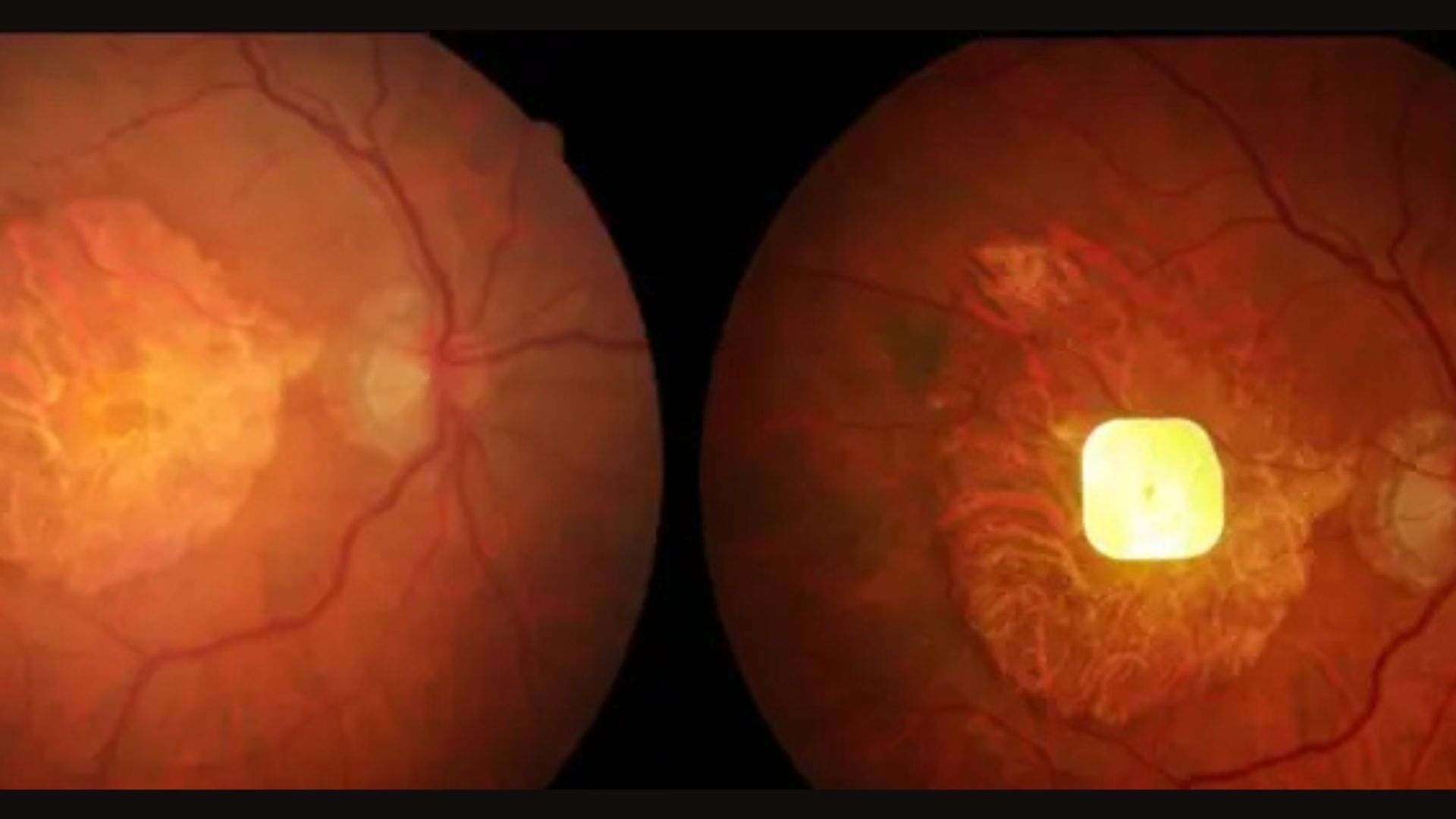 電子眼植入物助盲人重拾視力能力